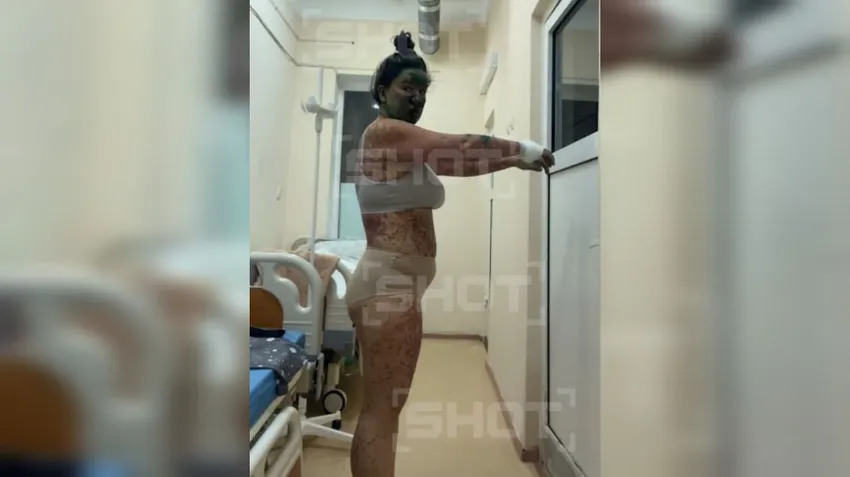 У жительницы Тюмени появились язвы и сыпь на теле после приема жаропонижающих. Фото: t.me/shot_shot