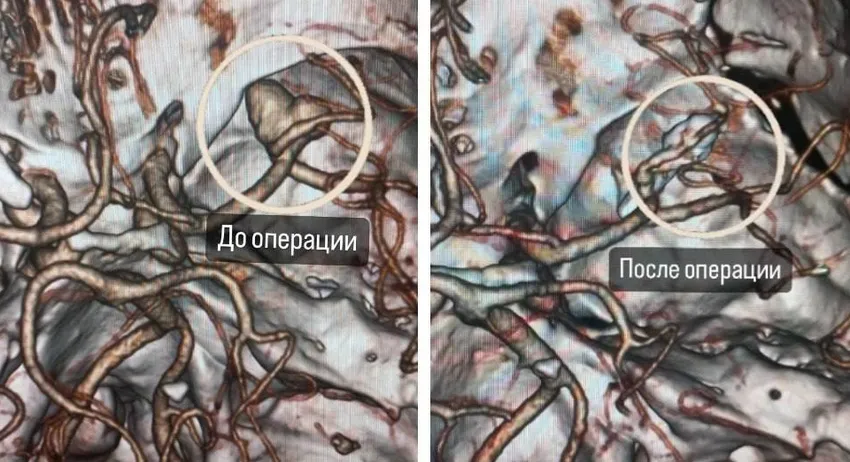 У жителя Долгопрудного удалили аневризму в форме сердечка. Фото: (Минздрав Московской области)/vk.com/minzdrav_mo