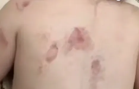 В Дагестане в детсаду девочку искусали до синяков, пока воспитательница отошла. Фото: t.me/mash_gor