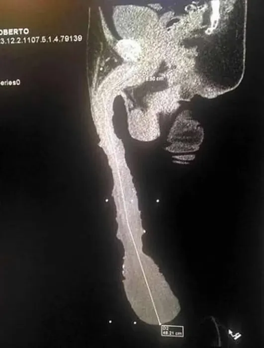 Доктора серьезно опасаются за здоровье мексиканского мачо. Фото: dailymail.co.uk