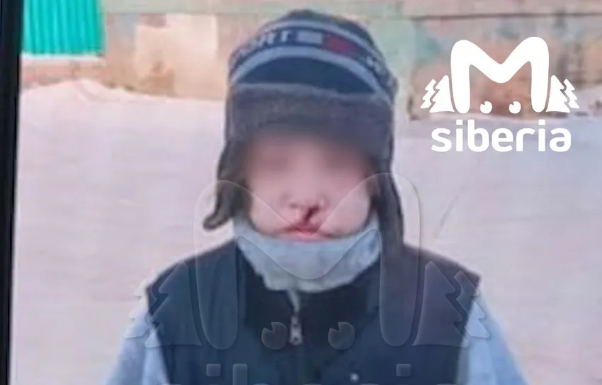 "Такое - впервые". Врачи в шоке от ран мальчика из Сибири, которому отчим порезал лицо. Фото: t.me/mash_siberia