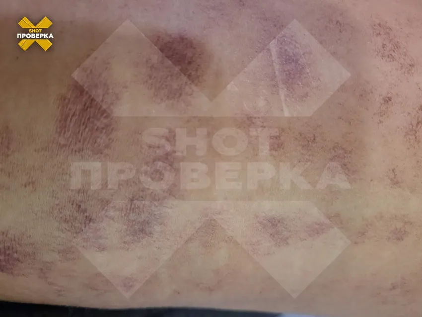 Пострадавшая запечатлела последствия применения лазера, часть тела покрылась гнойниками, из-за чего девушке потребовалась пересадка кожи. Фото: @t.me/+7_4at4ePQ7tjNjYy