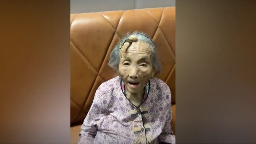 У 107-летней китаянки на лбу вырос рог. Фото: New York Post