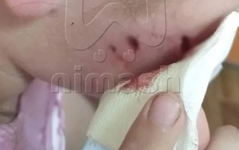 В Нижнем Новгороде домашняя собака напала на девочку и порвала ей лицо. Фото: t.me/mash_nimash