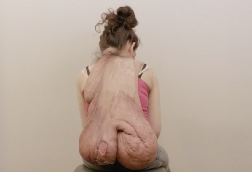 Опухоль на шее Александры достигла огромных размеров. Фото: dailymail.co.uk