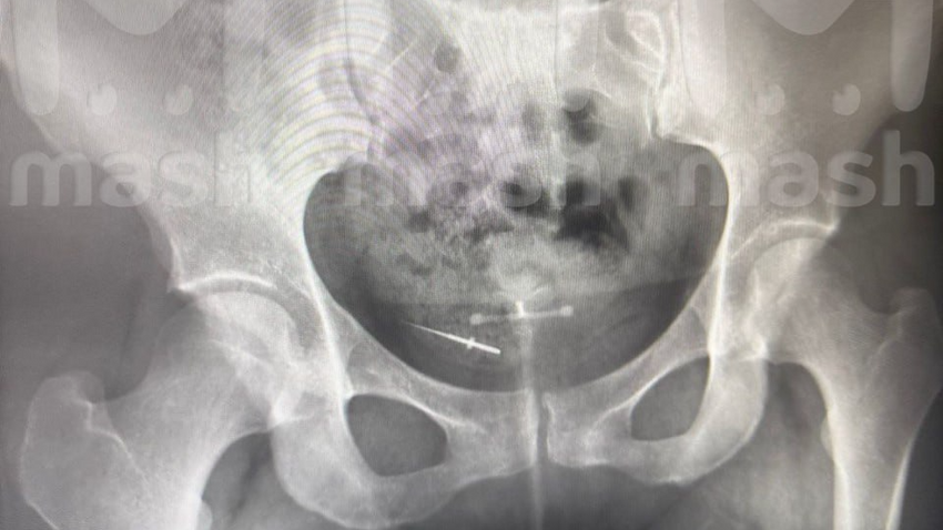 В Уфе врачи нашли в кишечнике пациентки стоматолога забытую после приема иголку. Фото: @breakingmash