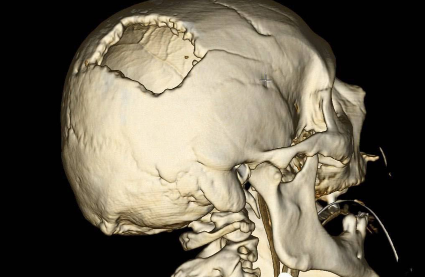 На Урале врачи спасли рабочего, которому стрела башенного крана пробила череп. Фото: t.me/url_mash