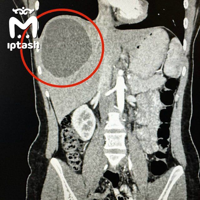 В Казани медики обнаружили в печени у 19-летней девушки огромный ком червей. Фото: @mash_iptash