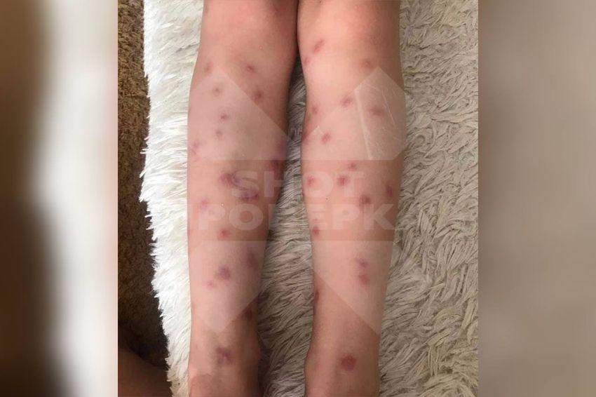 В России купальщиков атакуют личинки: проникнув под кожу, они могут вызвать анафилактический шок. Фото: @t.me/shot_proverka