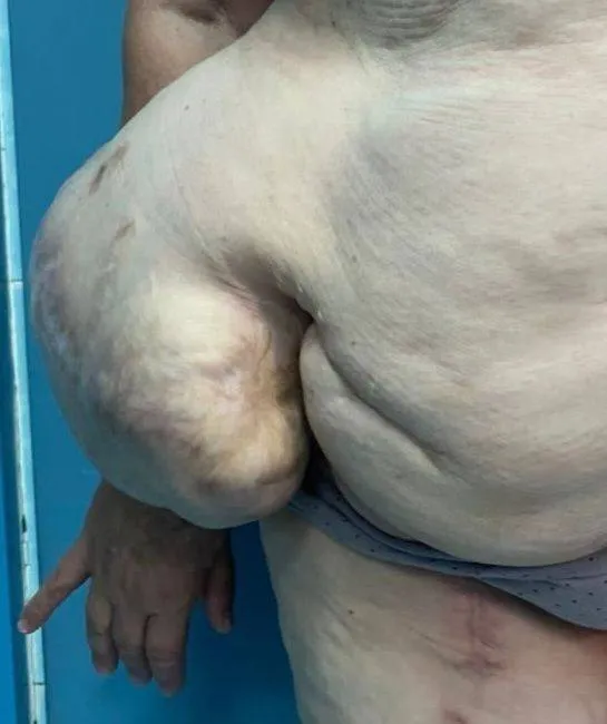 Страшная грыжа. Фото: vk.com/gkb1_pirogova