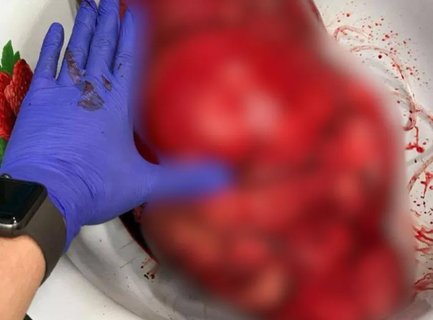 Во Владивостоке врачи спасли женщину, вырезав из ее живота гигантскую опухоль. Фото: t.me/amur_mash