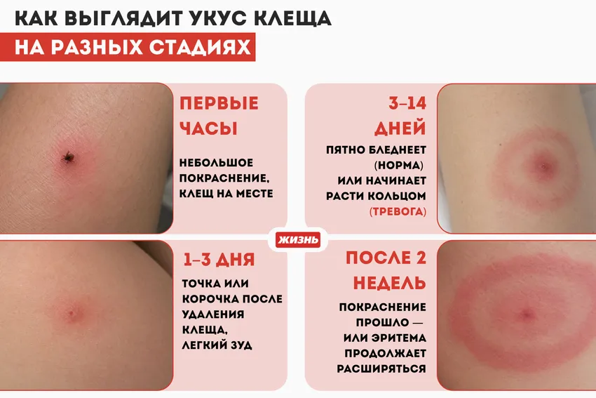 Как выглядит укус клеща (фото). Коллаж: Гавришева Анна