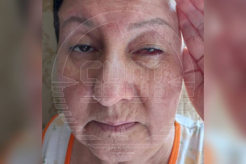 61-летняя пострадавшая Зифа Зинуровна показала, что стало с ее глазом. Фото: @t.me/shot_shot