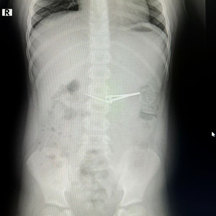 В Башкирии шестилетний мальчик проглотил щипчики для стрижки ногтей. Фото: @mash_batash