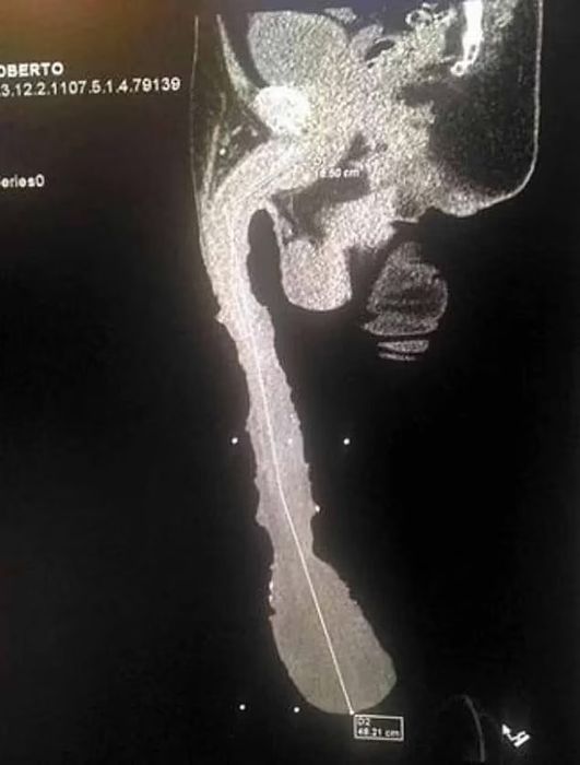 Доктора серьезно опасаются за здоровье мексиканского мачо. Фото: dailymail.co.uk