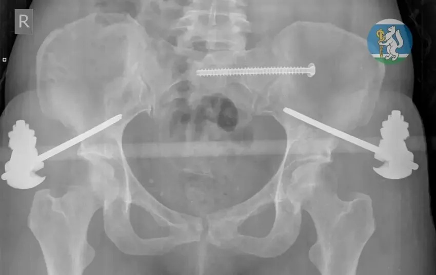 В Екатеринбурге врачи спасли 36-летнюю женщину, выжившую после падения с 7 этажа. Фото: соцсети