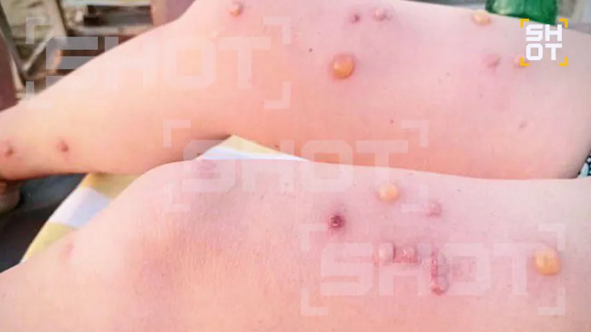 В Гоа российские туристы страдают от тигровых комаров, переносящих лихорадку. Фото: t.me/shot_shot