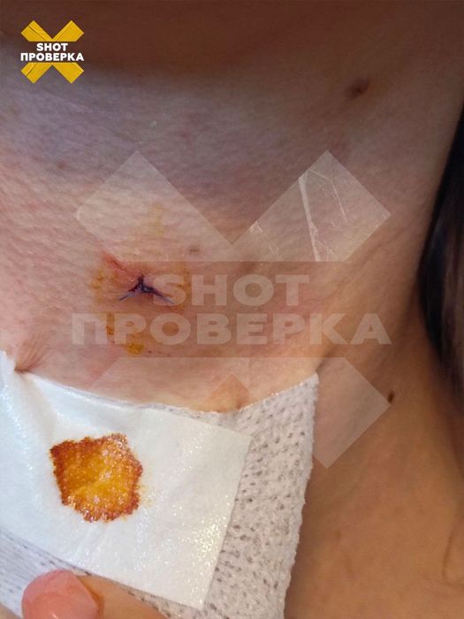 Зашитая рана на шее. Фото: @shot_proverka
