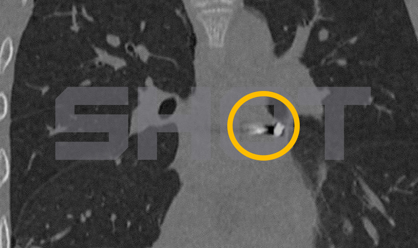 В Подмосковье врачи спасли парня, которому друзья случайно выстрелили в сердце. Фото: t.me/shot_shot