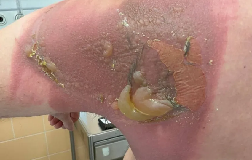 В Татарстане парень сжег спину, поспав на белье, постиранном с средством из Азии. Фото: @breakingmash