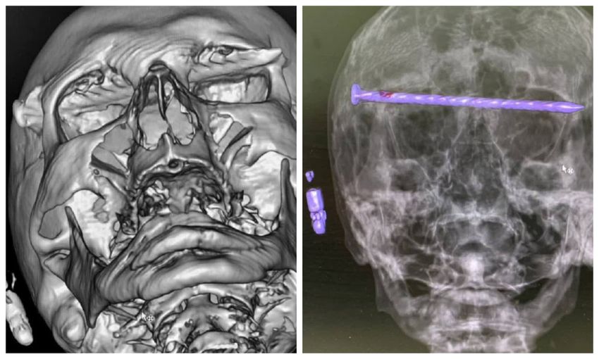 Гвоздь проткнул обе глазницы. Фото: @t.me/url_mash