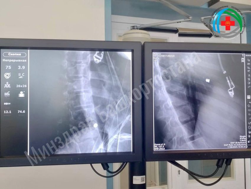 В Башкирии врачи спасли 11-летнюю девочку, которой пуля пробила легкое. Фото: t.me/mash_batash
