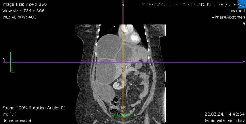 Женщине провели томографию и обнаружили четыре огромных кисты с гельминтами. Фото: rostgmu.ru