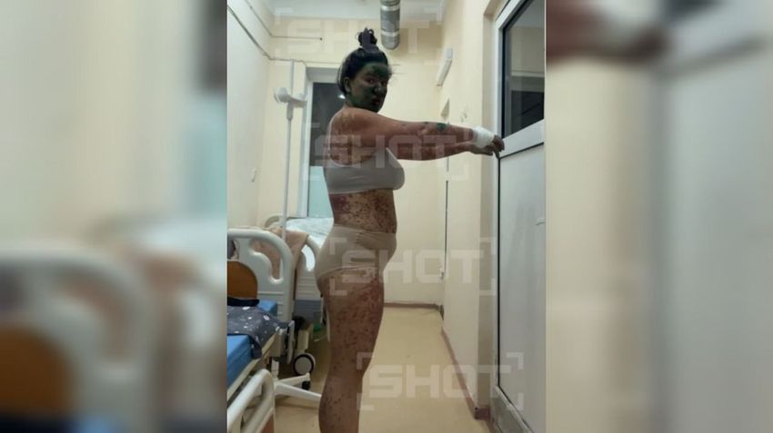 У жительницы Тюмени появились язвы и сыпь на теле после приема жаропонижающих. Фото: t.me/shot_shot