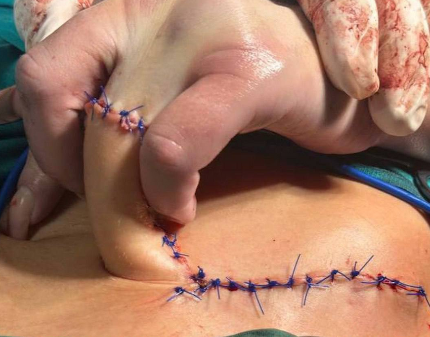 В Татарстане врачи пришили девушке оторванный палец к животу, чтобы вылечить. Фото: t.me/mash_iptash