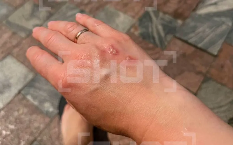 Во Вьетнаме россиян терроризируют жуки, чьи укусы оставляют волдыри и ожоги. Фото: t.me/shot_shot