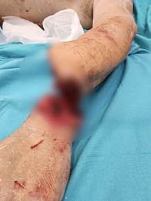 В Нижнем Новгороде врачи пришили мужчине руку, оторванную дисковой пилой. Фото: t.me/mash_nimash