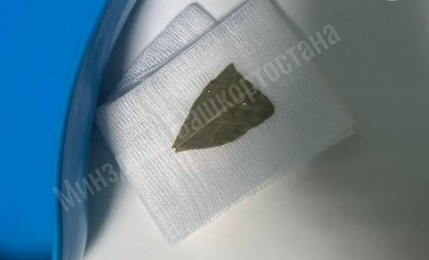 В Башкирии врачи спасли женщину, которая задыхалась из-за съеденной лаврушки. Фото: соцсети