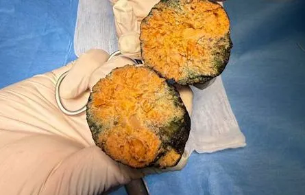 В Улан-Удэ у мужчины из-за съеденной хурмы в животе образовался "камень". Фото: t.me/babr_mash