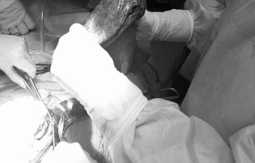 В Калининграде врачи спасли 13-летнюю девочку, удалив ей трехлитровую кисту. Фото: t.me/amber_mash