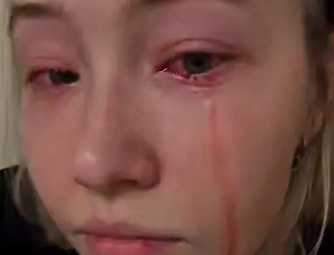 В Татарстане у девушки из глаз пошла кровь из-за химожога от наращивания ресниц. Фото: t.me/shot_proverka
