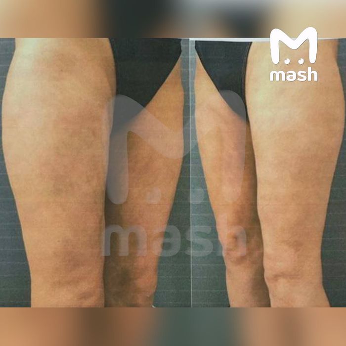 В Краснодаре женщине после неудачной липосакции ягодиц грозит ампутация ног. Фото: @breakingmash