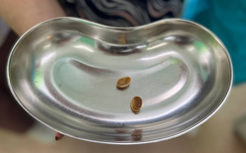 Жительница Лобни проглотила скорлупу от ореха примерно год назад. Фото: @t.me/shot_shot