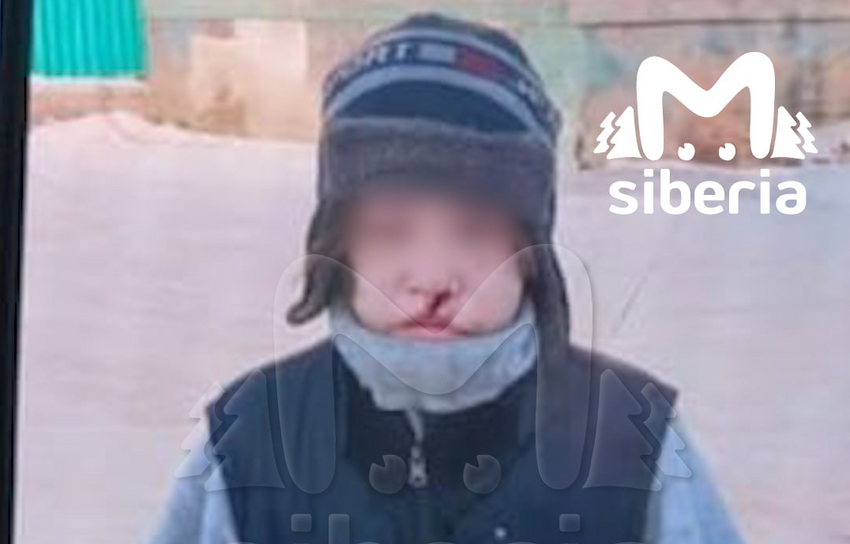 "Такое - впервые". Врачи в шоке от ран мальчика из Сибири, которому отчим порезал лицо. Фото: t.me/mash_siberia