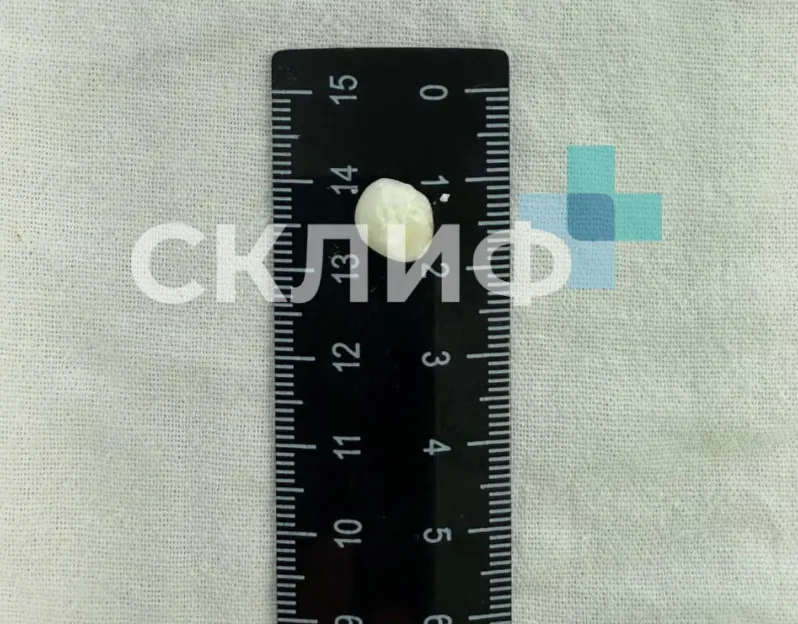 В Склифе врачи достали из печени 36-летней пациентки множество настоящих зубов. Фото: t.me/sklifofficial