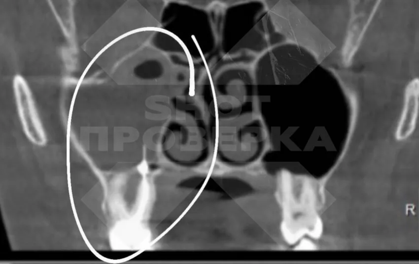 У россиянки в носу вырос гриб из-за застрявшего там 16 лет назад инструмента. Фото: t.me/+CKMg8rbNt904YzIy
