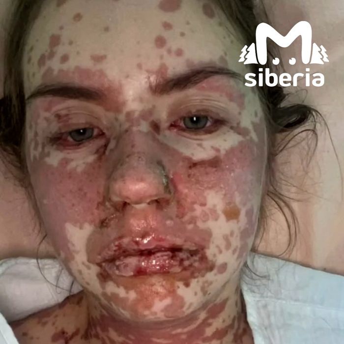Карина сильно пострадала из-за развившихся у нее синдромов. Фото: t.me/mash_siberia