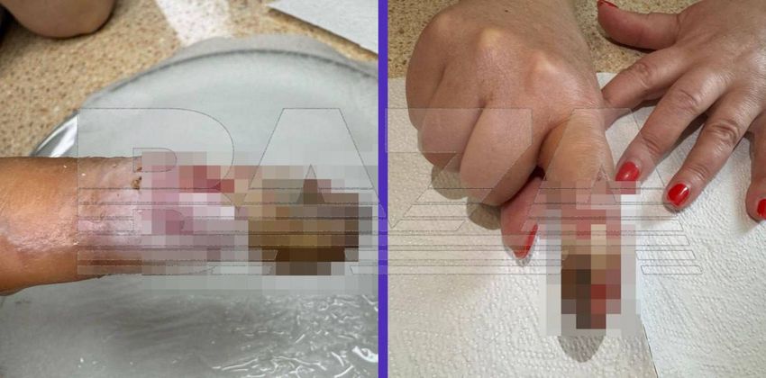 В Подмосковье женщина осталась без пальца по вине хирурга из частной клиники. Фото: t.me/bazabazon