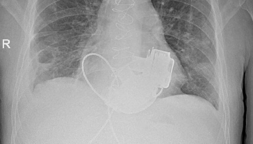 В России врачи впервые создали пациенту механическое сердце и спасли ему жизнь. Фото: t.me/mashmoyka