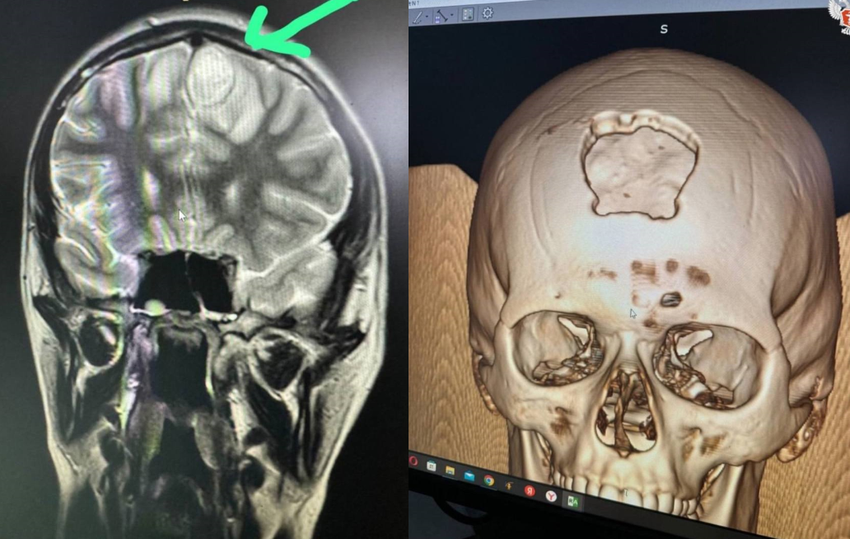 На фоне ОРВИ у мальчика развился абсцесс в мозгу. Фото: vk.com/minzdravru
