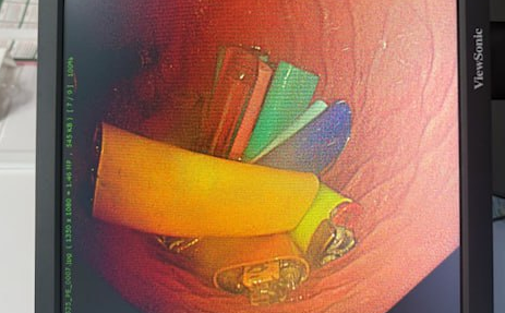 В Тыве из желудка 56-летнего мужчины извлекли 27 зажигалок. Фото: t.me/mash_siberia