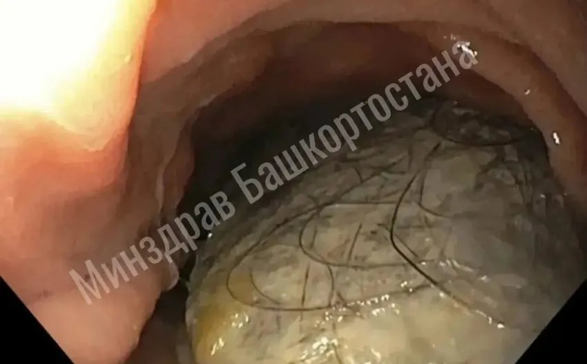 В Башкирии врачи спасли 16-летнюю девочку, достав из ее желудка комок волос. Фото: соцсети