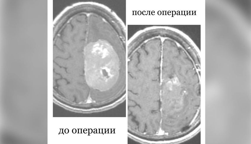 В Бурятии медики спасли пациентку с опухолью мозга: женщина шесть лет отказывалась от операции. Фото: vk.com/rkbsemashko