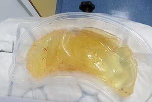 Фирма, выпускающая имплантаты, использовала промышленный силикон, предназначенный для матрасов. Фото: T.ME/IZNANKAWOMEN