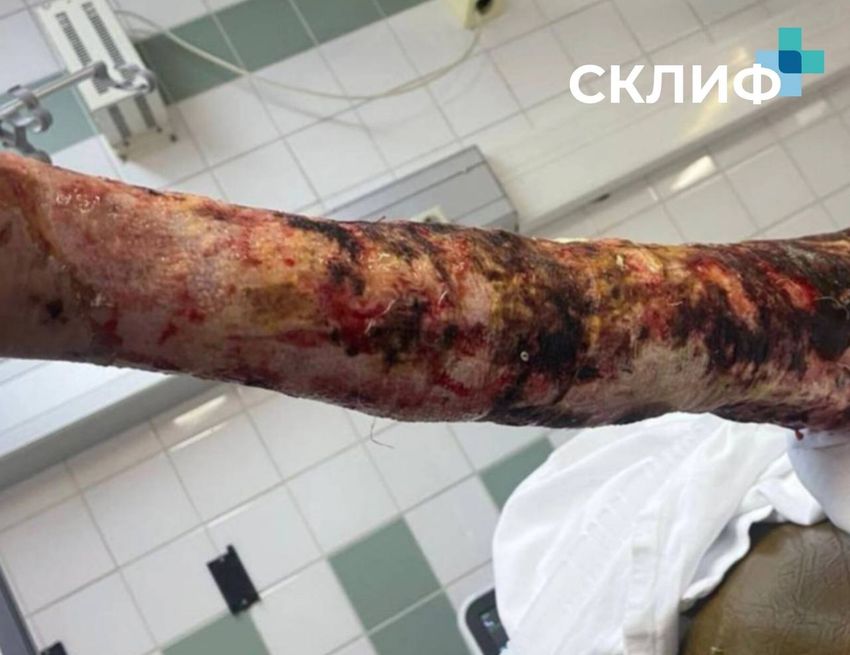 Страшные ожоги, которые врачам удалось вылечить. Фото: vk.com/sklif.official