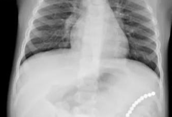 В Екатеринбурге врачи чудом спасли пятилетнюю девочку, проглотившую 10 магнитов. Фото: t.me/url_mash